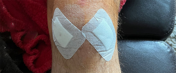 Ein frisch operiertes Knie mit zwei Pflastern